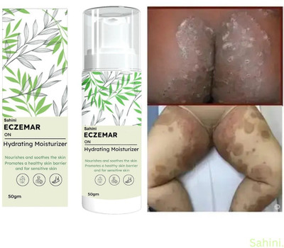 sahini Eczema & Fungal Solution With Soothing Botanicals(50 g)
