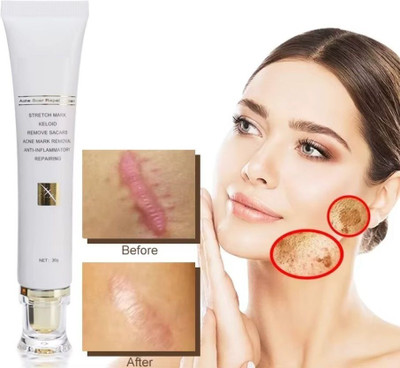 Flawls HNS Skin Brightening Scar & Acne Removal Cream(30 g)