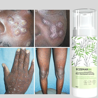 Eczemaron Ringworm Itching Anti fungal cream - for Ringworm, itching, Eczema & Fungal Infection Best Fungal Cream(52 g)