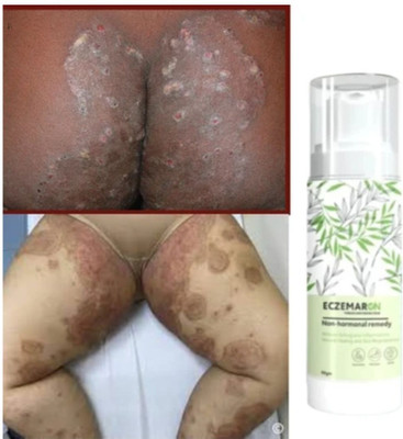 BIFRRUTANT Eczemaron anti fungal cream herbal spray quick rash treatment(50 ml)