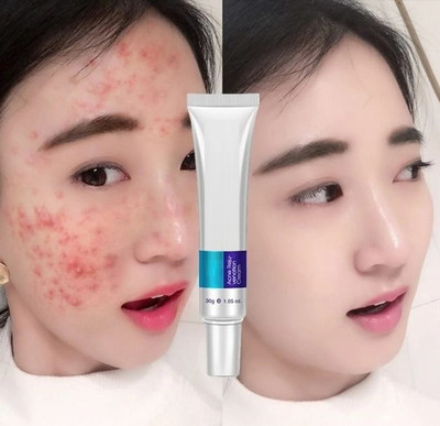 GFSU - GO FOR SOMETHING UNIQUE Best cream, Pimple Marks, Acne Scar, Pigmentation Blemish Removal--01(30 g)