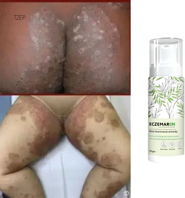 TZEP Eczemaron Anti Fungal Cream | Long Lasting Protection - Soothing Effect(50 ml)