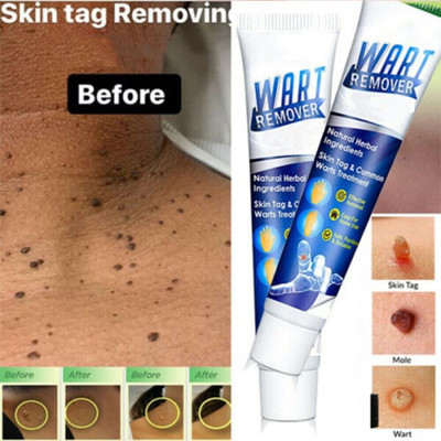 house of common Wart Remover Cream, Massa Removal Cream(100 g)