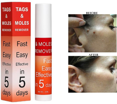 ODDEVEN Natural Wart Remover Liquid – Gentle Skin Tag & Mole Removal(5 ml)