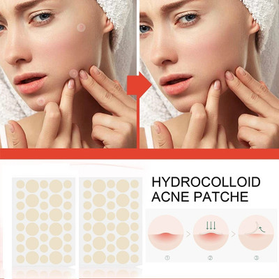 tanvi27 Acne Pimple Patches for Acne, Pimple, Blemish(10 g)