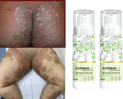 LORSHEL Eczemaron Anti Fungal Cream - gentle on sensitive and dry skin, reduces infla...(100 ml)