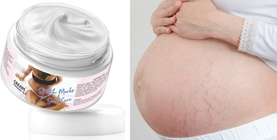 ADJD Vitamin c Stretch Marks & Scars Reducing During Treatment- Effective & Fast Working(50 g)