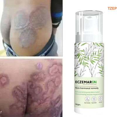TZEP Eczemaron anti fungal cream advanced protection from recurring infections(50 ml)