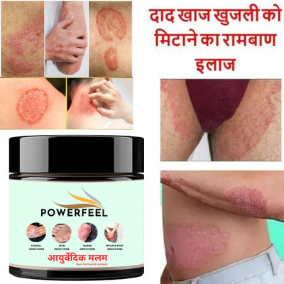 POWERFEEL Ayurvedic -Anti fungal Malam - for Ringworm, Eczema & Fungal Infection(50 g)