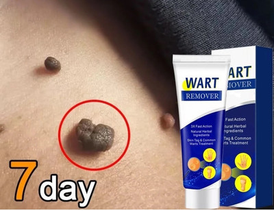MYEONG Mole Wart & Tags Remover Cream For Men & Women(100 g)