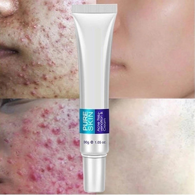 GFSU - GO FOR SOMETHING UNIQUE Cream for Old & New Acne Pits and Acne Scars(30 g)