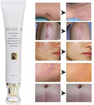 Qorelya Skin Brightening and Scar Removal Cream for Radiant Skin(30 g)