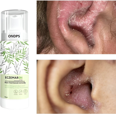 ONDPS Eczemaron Anti Fungal Cream For Men & Women(50 g)