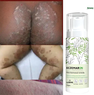 LORSHEL Eczemaron Anti Fungal Cream | Rash Protection, Non Invasive(50 ml)