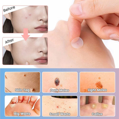 tanvi27 Acne Rapid Healing & Invisible Coverage Acne Patch(10 g)
