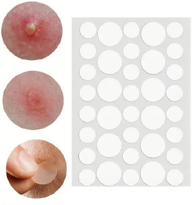 WOONGMI Pimple Acne Patch Hydrocolloid Waterproof Patches(10 g)