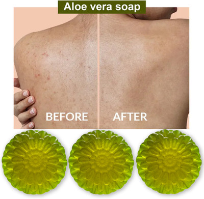 CHITAKSH Aloe Vera Soap with Tea Tree Oil (100GM) (PACK OF 3)(300 g)