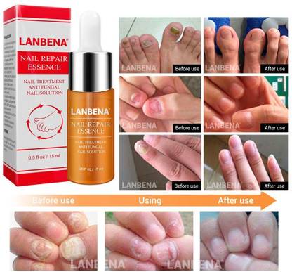 LANBENA Nail Repair Essence (Anti-Fungal) - Remove Onychomycosis - Nail Repair, Whitening & Treatment Antiseptic Liquid Price in India - Buy LANBENA Nail Repair Essence (Anti-Fungal) - Remove Onychomycosis - Nail Repair, LANBENA Nail Repair Essence (Anti-Fungal) - Remove Onychomycosis - Nail Repair, Whitening & Treatment Antiseptic Liquid Price in India - Buy LANBENA Nail Repair Essence (Anti-Fungal) - Remove Onychomycosis - Nail Repair,