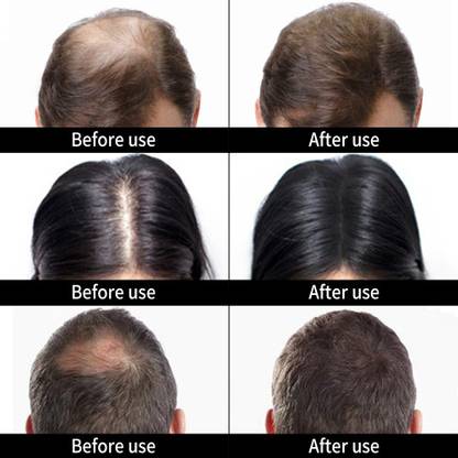 Osking Caboki Hair Loss concealer DARK BROWN Color(30 grams) Hair Building Fiber DB30G95 Soft Hair Volumizer Powder Price in India - Buy Osking Caboki Hair Loss concealer DARK BROWN Color(30 grams) Hair Osking Caboki Hair Loss concealer DARK BROWN Color(30 grams) Hair Building Fiber DB30G95 Soft Hair Volumizer Powder Price in India - Buy Osking Caboki Hair Loss concealer DARK BROWN Color(30 grams) Hair