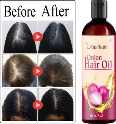 berrisom Advance Onion Hair Oil For Fast Hair Growth With 14 Essentials Hair Oil - Price in India, Buy berrisom Advance Onion Hair Oil For Fast Hair Growth With 14 Essentials Hair berrisom Advance Onion Hair Oil For Fast Hair Growth With 14 Essentials Hair Oil - Price in India, Buy berrisom Advance Onion Hair Oil For Fast Hair Growth With 14 Essentials Hair