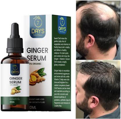 7 Days Natural Hair Loss Treatment Ginger Germinal Serum Essence Oil Hair  Oil - Price in India, Buy 7 Days Natural Hair Loss Treatment Ginger  Germinal Serum Essence Oil Hair Oil Online