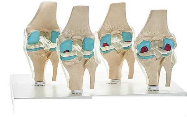 btc instruments 4 Stage Osteoarthritis Anatomical Knee Model, Model On Base, with Detailed Study Guide Anatomical Body Model