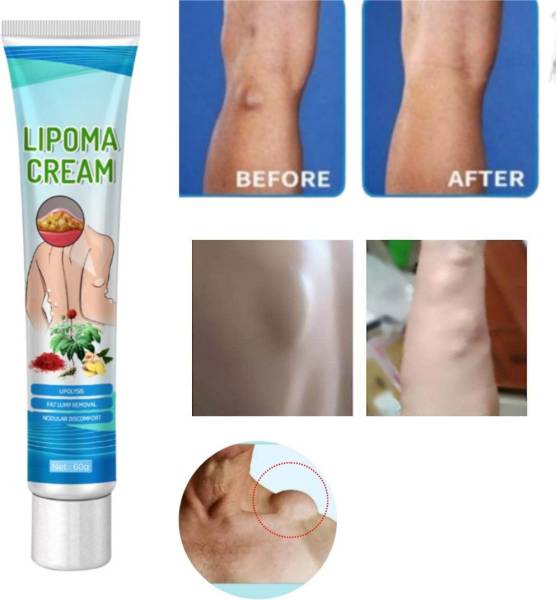 SIYDHA Lipoma Removal Herbal Cream For Men and Women Lipoma Drops Cream