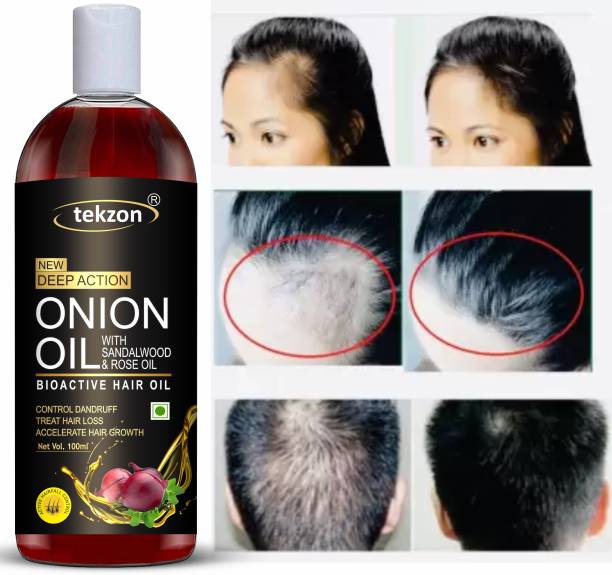 tekzon Bioactive Onion Hair Oil for Control Dandruff, Accelerate Hair Growth Hair Oil