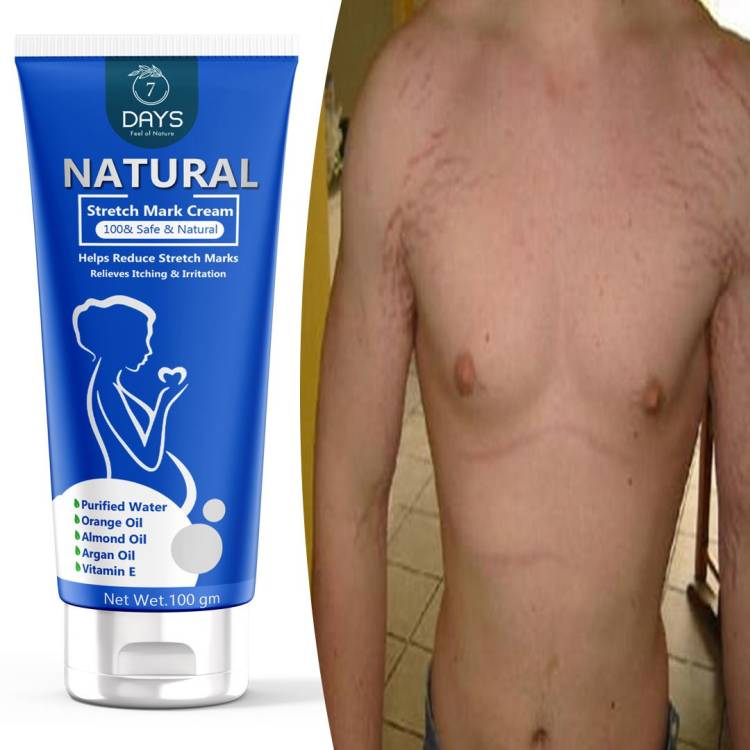 7 Days Stretch Marks Scar removal cream oil in during after pregnancy delivery women,organic Bio Oil for to remove Hyperpigmentation,anti Cellulite,remover scars uneven skin fast result 100% natural orgnic Price in India