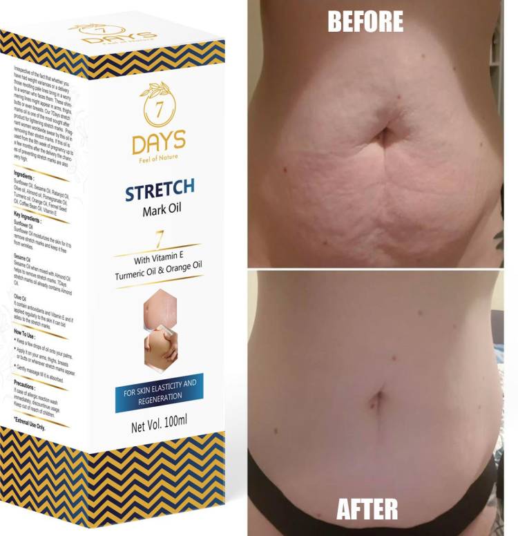 7 Days Stretch Marks Removal Post Pregnancy fast work 100% result stretch mark oil Men & Women Price in India