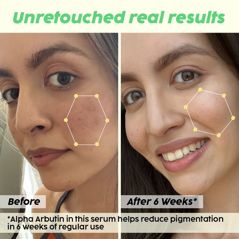 The Plant Fix Plix 2% Alpha Arbutin Pineapple Serum for Pigmentation & Dark Spot Reduction (10 ml) - Image 5