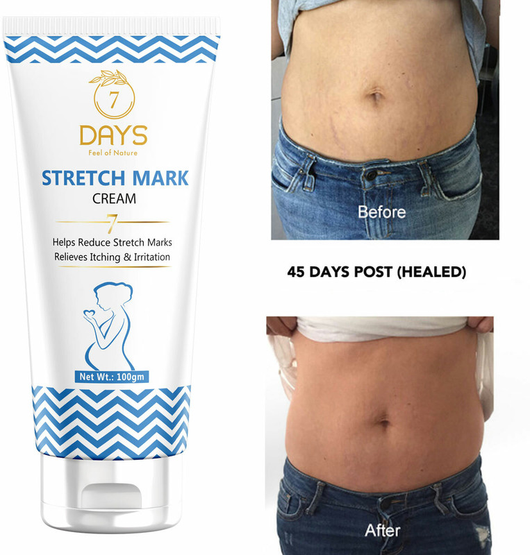 7 Days Natural after before under pregnancy stretch mark removal oil(100 g)