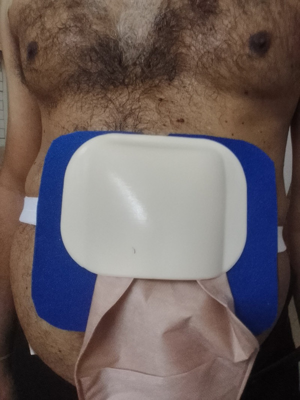 FLOVEIN STOMA GUARD FOR COLOSTOMY Bandage Protector(Adult & Kids Back)