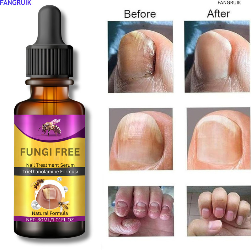 Fangruik Nail Fungal Repair Serum Nail Fungus Treatment Fast