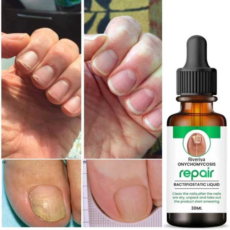 MOTYL Fungal Nail Treatment Liquid | Repair & Removal Solution for Nails (PACK OF 1) CLEAR