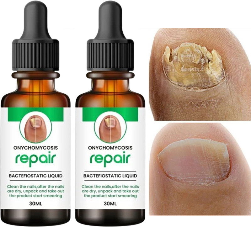 KORAT KING 100% Natural Nails Strong Oil For Cuticle Care, Nail Growth & Strength Yellow(Pack of 2)