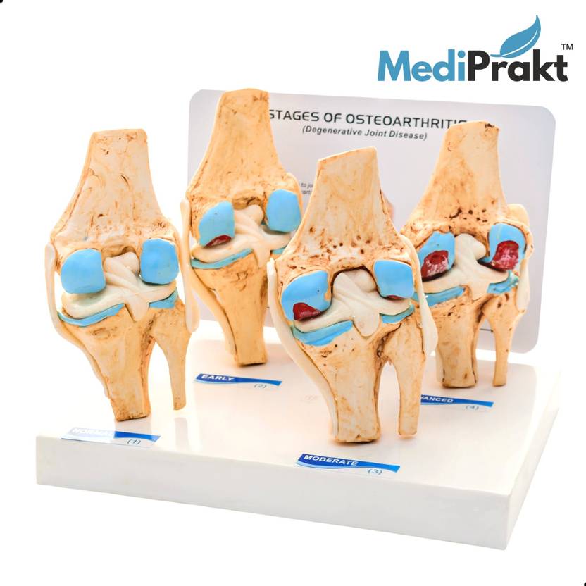 MediPrakt KNEE JOINT ARTHRITIS MODEL 4 Stage Osteoarthritis For
