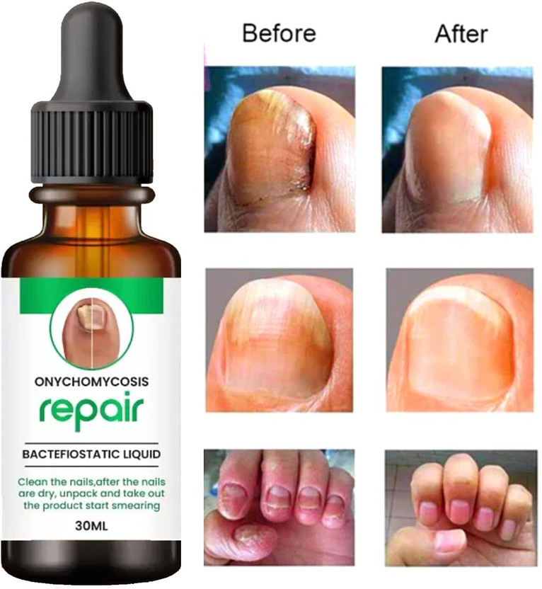 MILAN Enterprise nail growth oil/nail growth serum Nail Treatment Repair 40 ml Men & Women(40 ml)