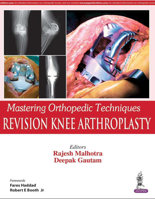 Mastering Orthopedic Techniques: Revision Knee Arthroplasty(English, Hardcover, Malhotra Rajesh)