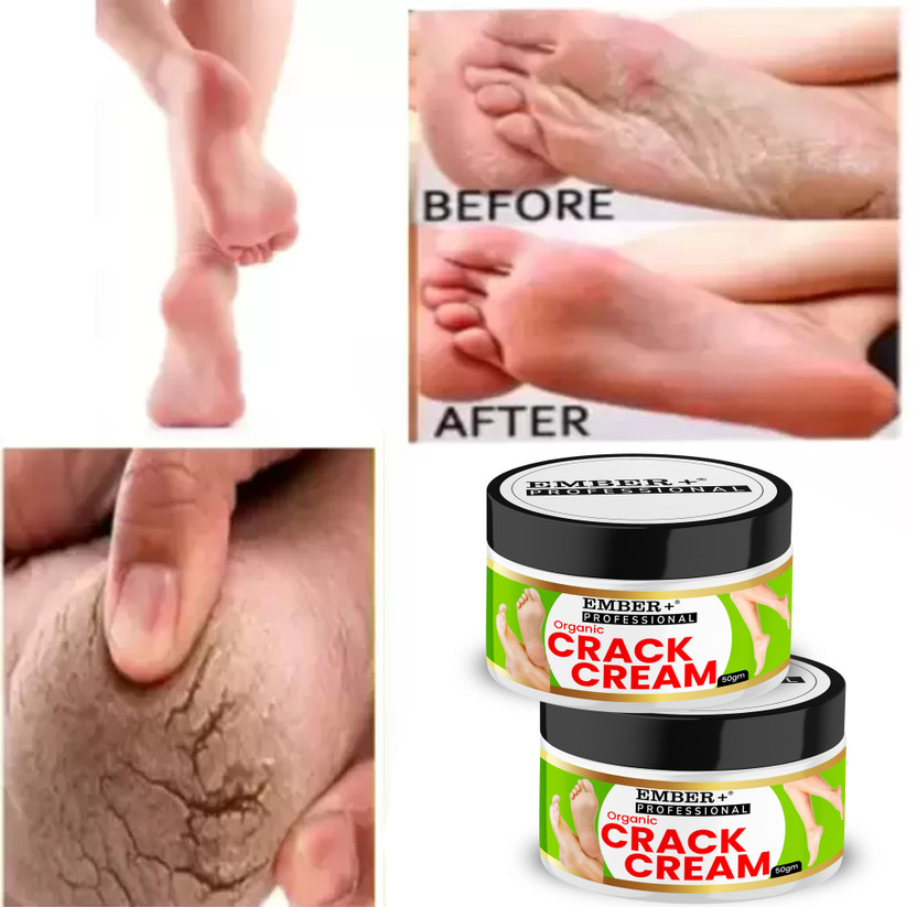 Ember Ember Cream For Rough, Dry and Cracked Heel And Hand, Feet And Hand Cream For Healing(100 g) - Flipkart Deal
