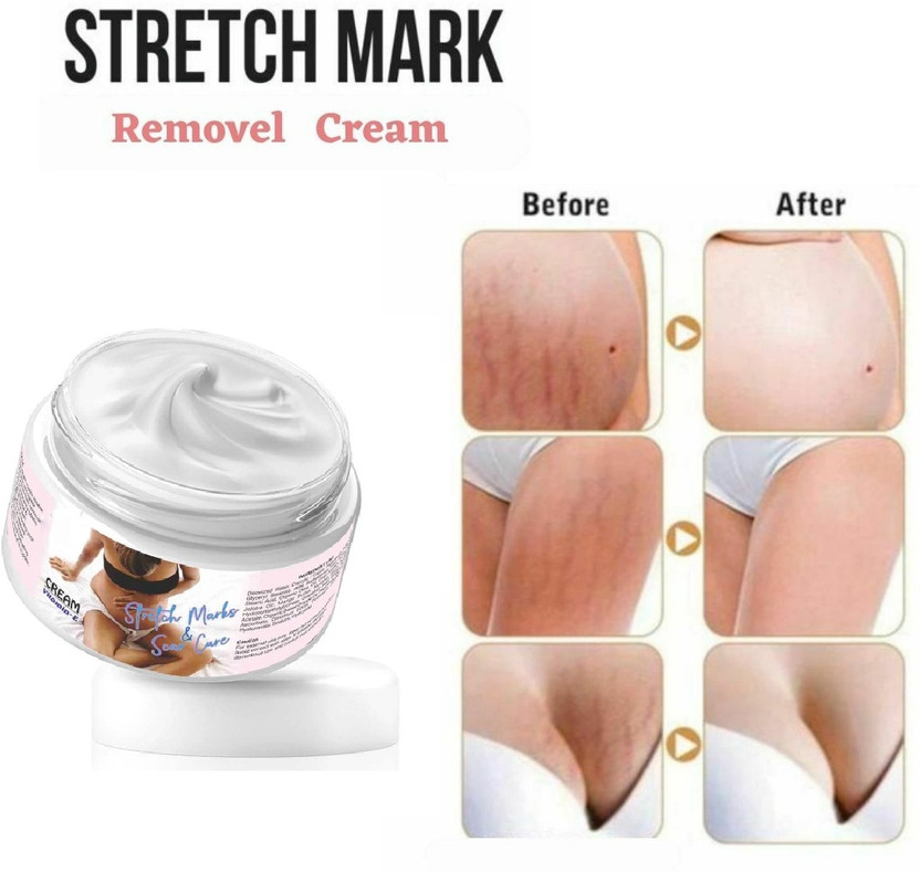 manasona Pregnancy stretch mark removal cream For Womens(50 g)