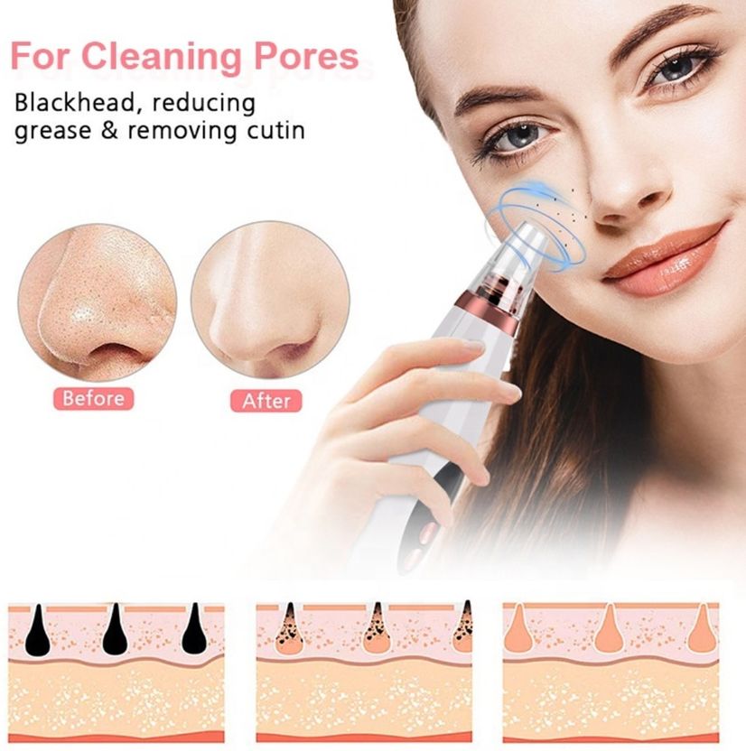 FURESTA Blackhead Remover Vacuum Suction Device (Pack of 1) - Image 5