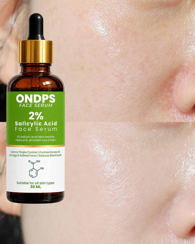 ONDPS XX Anti Acne 2% Salicylic Acid Face Serum | Reduces Excess Oil, Acne & Blackheads(30 ml)