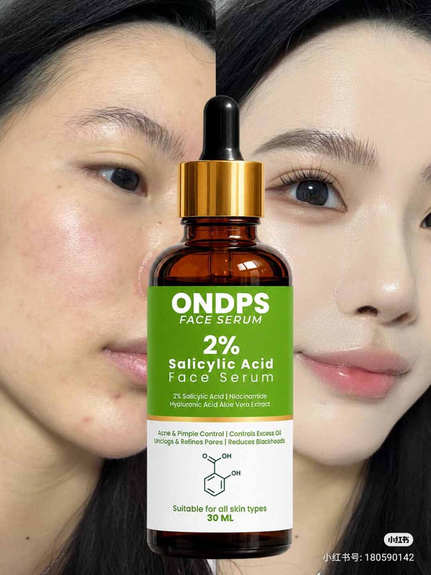 ONDPS X Anti Acne 2% Salicylic Acid Face Serum | Reduces Excess Oil, Acne & Blackheads(30 ml)