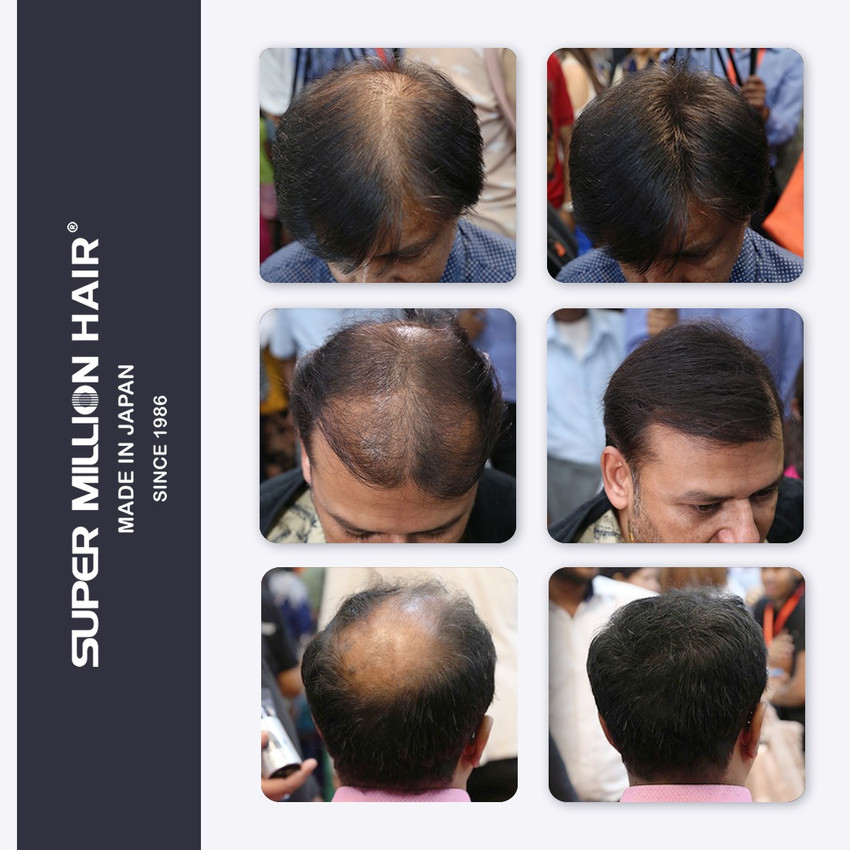 Aggregate 72+ kerrato hair fiber side effects best in.eteachers