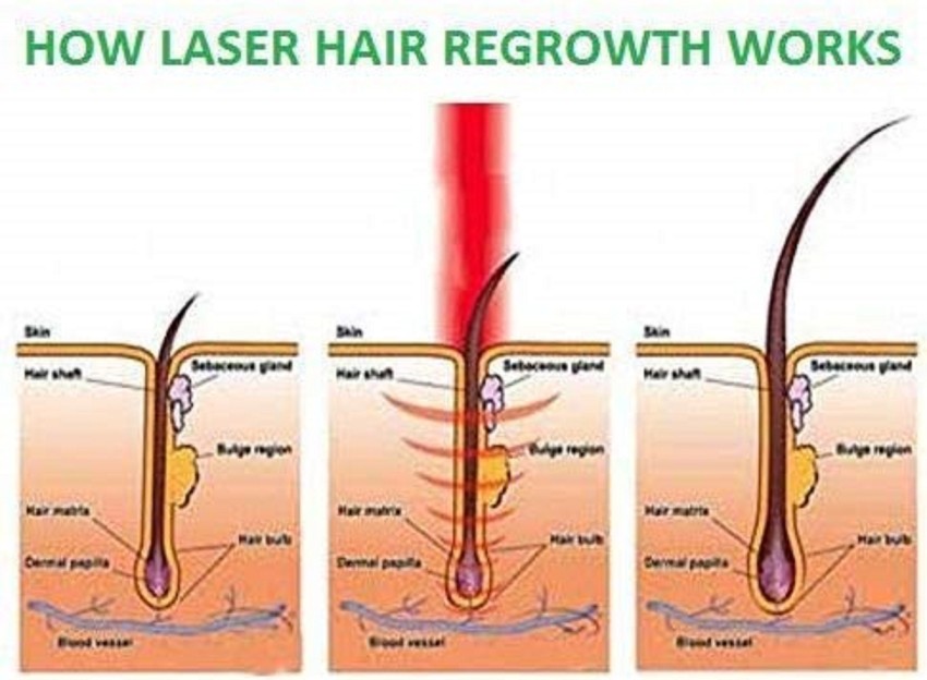 Laser Hair Growth Comb  Frankenbanana