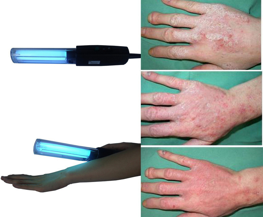 Uvb Light Therapy For Psoriasis Reviews Shelly Lighting