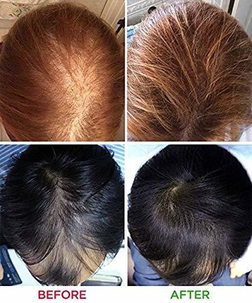 Theradome Laser Hair Growth Helmet  Advanced Hair Studio