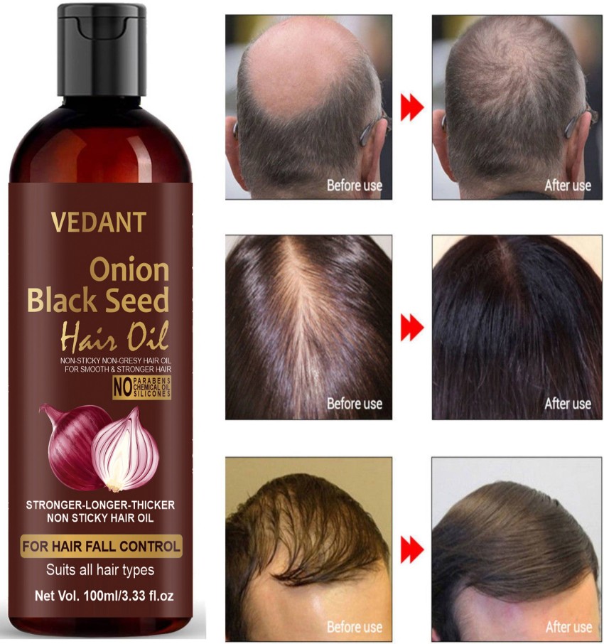 Orgenic Onion Hair Oil for Hair Regrowth and Anti Hair Loss  SaishSciVeda  Ayurvedic Product Online Store
