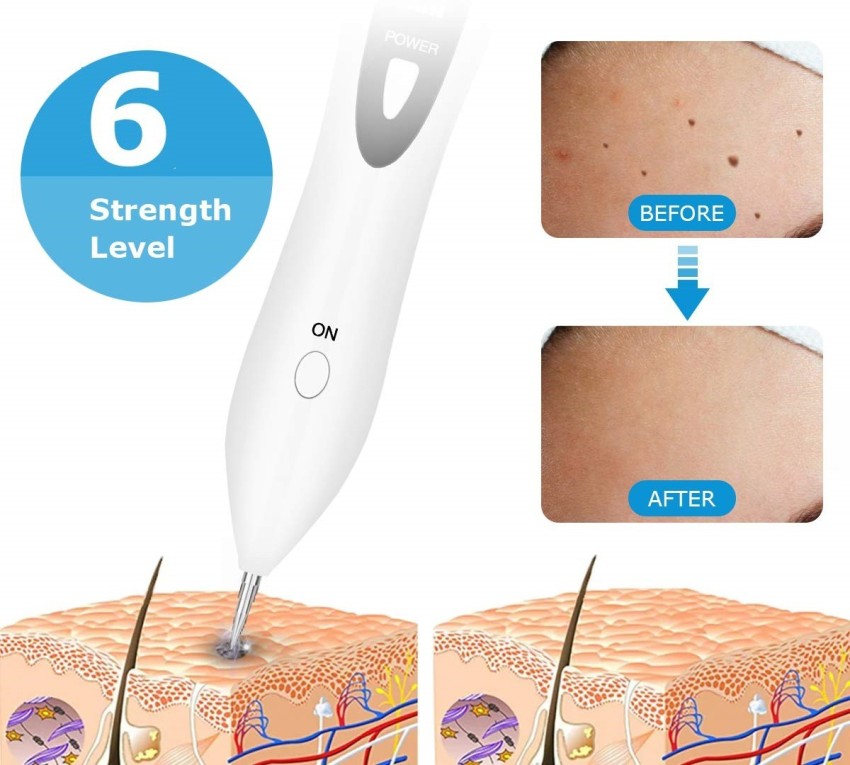 R A Products Picosecond Laser Pen Blue Light Therapy Tattoo Scar Mole  Freckle Removal Dark Spot Remover Machine Skin Care Beauty Mucus Removal  Device Price in India  Buy R A Products